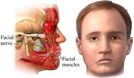 What is facial paralysis?